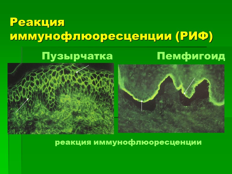 Реакция иммунофлюоресценции (РИФ)    реакция иммунофлюоресценции Пузырчатка     